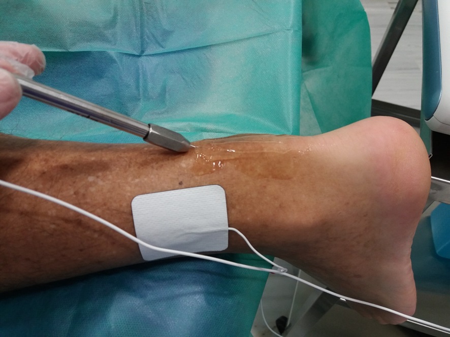 EPI-EPTE – Electrolisis Percutanea